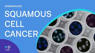 Squamous Cell Cancer Dermatology [upl. by Bennet]