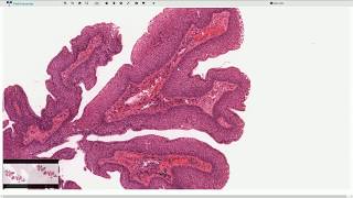 Squamous Papilloma  Larynx  Histopathology [upl. by Marisa870]