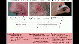 Anatomy  The Three Types of Skin Cancers [upl. by Lavud]