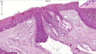 HSIL  High Grade Squamous Intraepithelial Lesion  Histopathology [upl. by Doone]